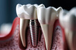 A close-up of a dental implant model highlighting the crown restoration. Concept of tooth replacement and function. Generative Ai.