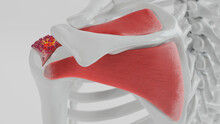 3D Rendering Of Calcific Tendonitis In The Shoulder