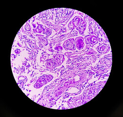 Sticker - Photomicrograph: Meningioma, the most common type of primary brain tumor