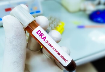 Poster - Blood sample for diabetic ketoacidosis (DKA) test. A complication of diabetes that can lead to a coma or even death.