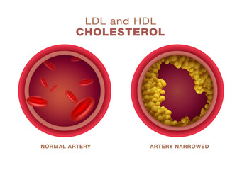 Types of comparison of atherosclerotic cholesterol with HDL and LDL lipoproteins. Cross section of normal and narrow arteries with clogged arteries. can cause high triglycerides. Vector illustration.