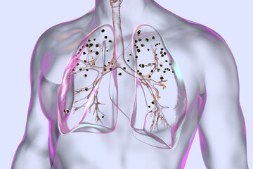 Wall Mural - Human lungs with silicosis, 3D illustration