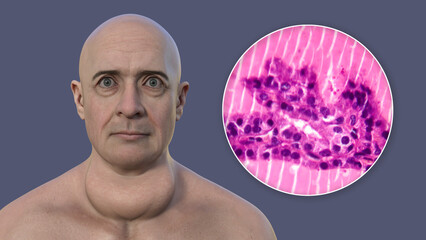 Wall Mural - A man with enlarged thyroid gland, 3D illustration, and micrograph toxic goiter