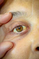 cancer patient. shot of the yellowish eyes. severe form of hepatitis. medical concept. life and health.