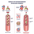 Impact of hypertension on blood vessels with high pressure outline diagram. Labeled educational scheme with healthy vs narrowed artery and turbulent flow vector illustration. Medical risk factors.