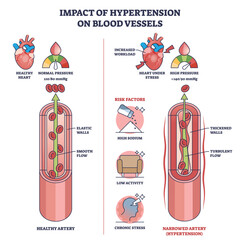 Poster - Impact of hypertension on blood vessels with high pressure outline diagram. Labeled educational scheme with healthy vs narrowed artery and turbulent flow vector illustration. Medical risk factors.