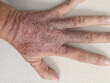 rash eczema dermatitis  on hand. inflammation of skin