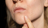 The woman skin flakes off at the mouth. Dry skin. Face skin irritation after peeling, after cold windy weather. Dark background, view by profile