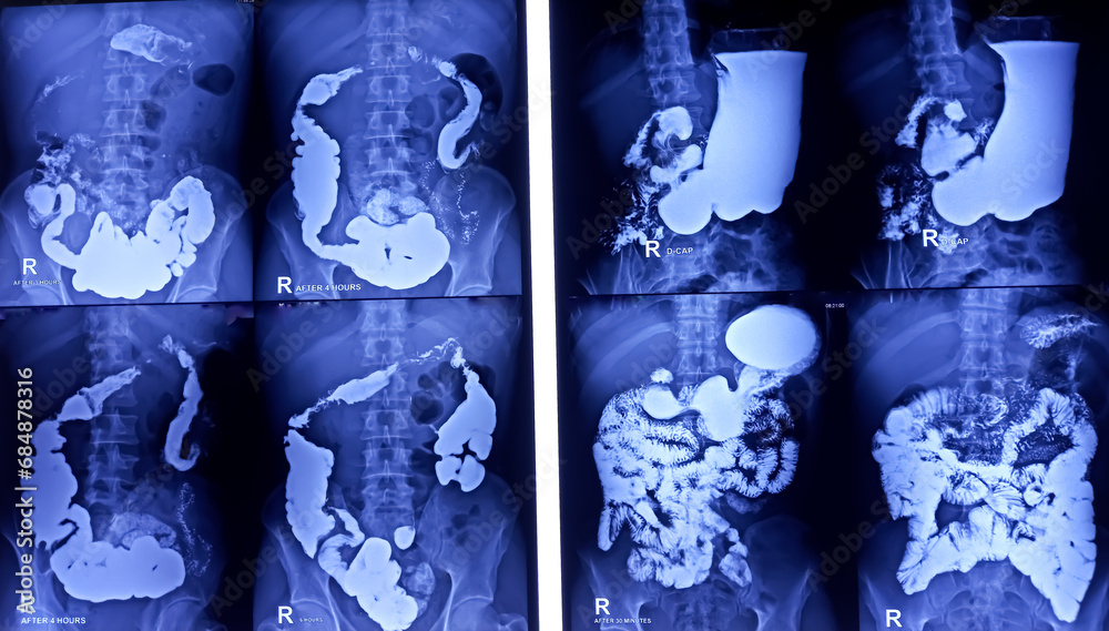 Mucosal Pattern Photo Stock Barium swallow of oesophagus examination x-ray. showing ...