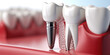 The precision of a tooth implant, fitting perfectly in the mouth, set against the backdrop of a high-tech dental clinic