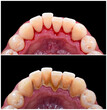 teeth deep cleaning before and after picture
