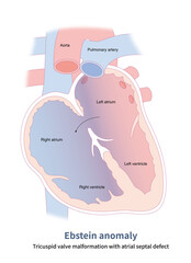 Wall Mural - Ebstein anomaly is a rare congenital heart condition in which the tricuspid valve shifts to the right ventricle, causing the right atrium to enlarge and the right ventricle to become smaller.