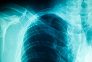 X-ray picture of shoulder and chest