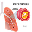 Cystic fibrosis illustration infection on lungs