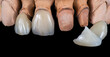 © Garo - emax crowns and veneers