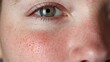 © AIGen - Enlarged Pores on Woman's Cheek. Closeup Macro Texture of Skin with Redness