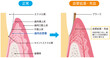 正常な歯茎と充血した歯茎の断面図　比較　歯科　医療