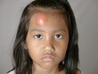 © airdone - Little Asian girl with swollen bump on her forehead