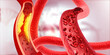 © Rasi - Clogged arteries on scientific background. 3d illustration.