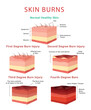 Skin burn classification infographic medical educational scheme poster isometric vector illustration