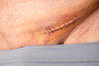 Nine staples to the groin scar on the body of an elderly gentleman after an inguinal hernia operation