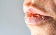 © Сергей Дудиков - Women's lips after high body temperature, lips cracked with blood. Dry lips.