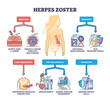 Herpes zoster infection medical symptoms and treatment outline diagram. Labeled educational scheme with skin shingle prevention, diet, lifestyle and long term effects explanation vector illustration.