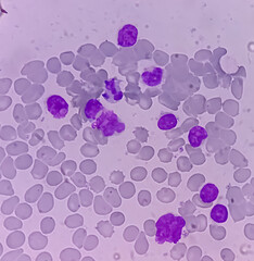 Poster - Leukemia. blood cells, blast cells and immature leukocytic cells in chronic lymphocytic leukemia, prolymphocytic leukemia, acute lymphoblastic leukemia.