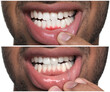 Man showing gum before and after treatment on white background, collage of photos