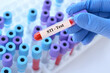 © syhin_stas - Doctor holding a test blood sample tube with STI (sexually transmitted infection) test on the background of medical test tubes with analyzes