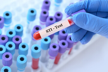 Doctor holding a test blood sample tube with STI (sexually transmitted infection) test on the background of medical test tubes with analyzes