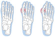 外反母趾　段階　足の骨　骨格図