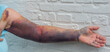 Hämatom Bluterguss am ganzen Arm durch ein Ellenbogenbruch
