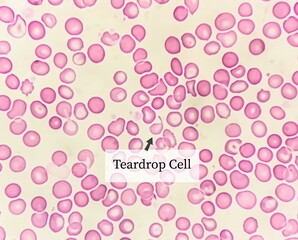 Wall Mural - Teardrop cells (dacrocytes) are frequently associated with infiltration of the bone marrow by fibrosis, granulomatous inflammation, hematopoietic or metastatic neoplasms.