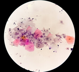 Canvas Print - Photomicrograph of Paps smear: Inflammatory smear with HPV related changes. Cervical cancer. SCC