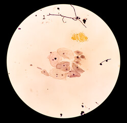 Poster - Photomicrograph of Paps smear: Inflammatory smear with HPV related changes. Cervical cancer. SCC