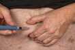 Diabetes Management: Injecting Insulin into Belly with Insulin Pen
