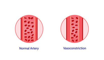 Wall Mural - Arterial vasoconstriction. Cross section of arteries. Comparison of normal and constricted blood vessels. Scientific Diagram. Vector illustration.