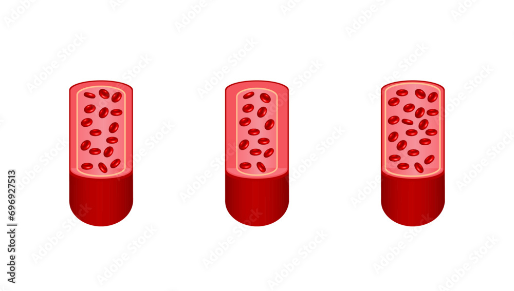 Arterial vasoconstriction and vasodilation. Cross section of arteries ...