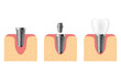 Dental implant. Realistic implant structure, graphic models of the crown. Screw prosthesis, orthodontic dental implantation