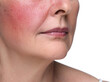 © New Africa - Woman with rosacea on white background, closeup. Problem skin treatment