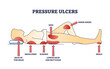 Pressure ulcers or bedsores skin tissue injuries locations outline diagram. Labeled educational scheme with stationary laying patient caused dermatological conditions on body vector illustration.