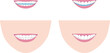 笑顔の歯列の見え方ベクターイラスト。スマイルラインのカーブとストレートライン