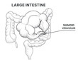 Bowel obstruction. Sigmoid volvulus. Line art drawing. Healthcare illustration. Vector illustration. 