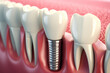 Concept prosthetics Implant tooth attached to jaw with pin