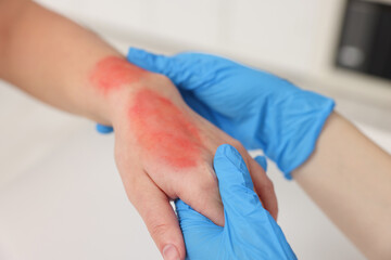 Canvas Print - Doctor examining patient's burned hand indoors, closeup