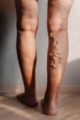 Varicose veins in a woman. swelling of veins in the legs of an elderly person. clogged veins with plugs on a person's legs