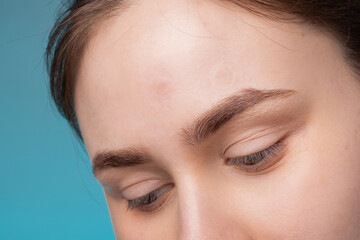 girl with acne stick round acne patch on her cheek. using acne patches for treatment of pimple and r