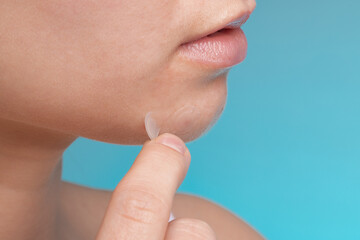 girl with acne stick round acne patch on her cheek. using acne patches for treatment of pimple and r