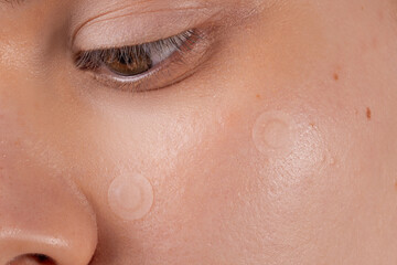 girl with acne stick round acne patch on her cheek. using acne patches for treatment of pimple and r